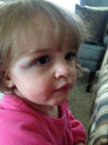 I have a black eye because I fought with a coffee table!